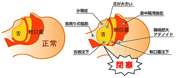 SASの原因としくみ