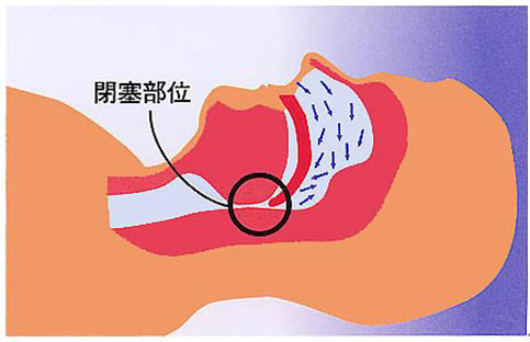 CPAPのしくみ　睡眠時無呼吸状態