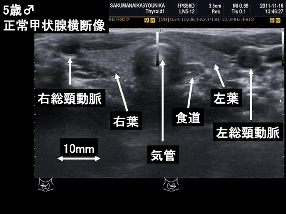 5歳♂　正常甲状腺横断像