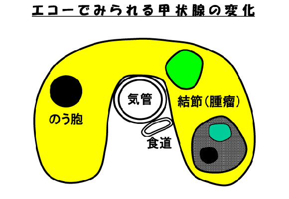 エコーでみられる甲状腺の変化