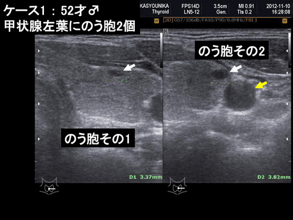 ケース1：52才♂　甲状腺左葉にのう胞2個