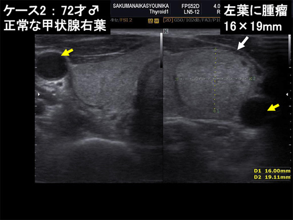 ケース2：72才♂　正常な甲状腺右葉