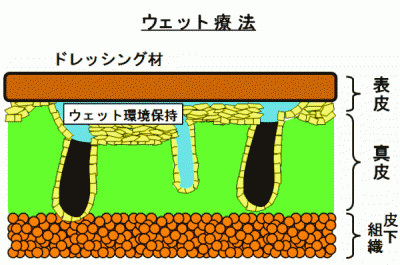 ウェット療法