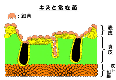 キズと常在菌