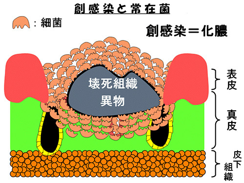 創感染と常在菌