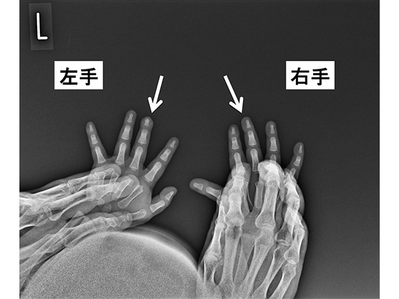 左手右手のレントゲン